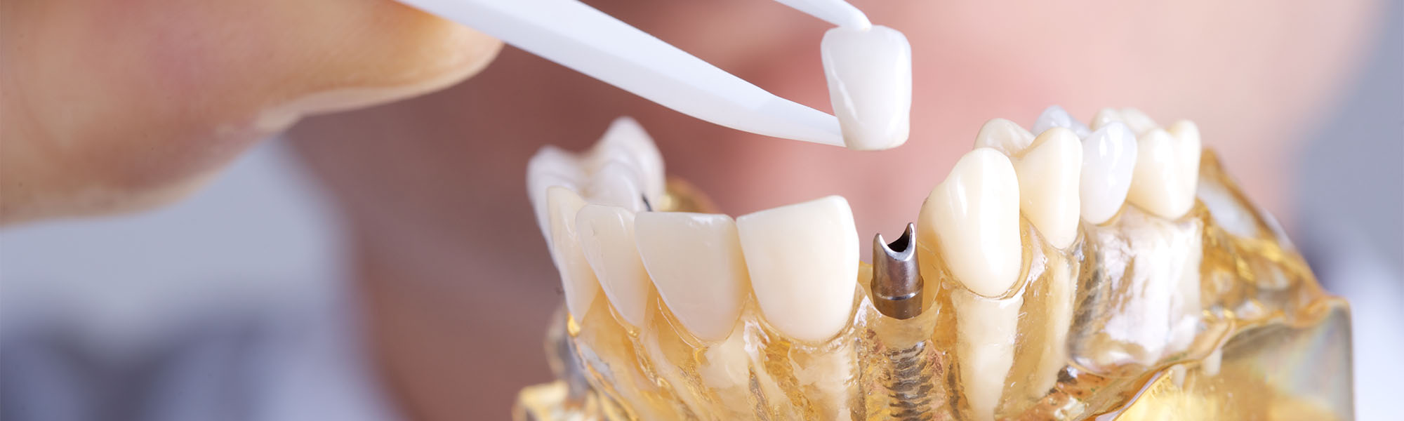 Single Tooth Implants Torrance CA