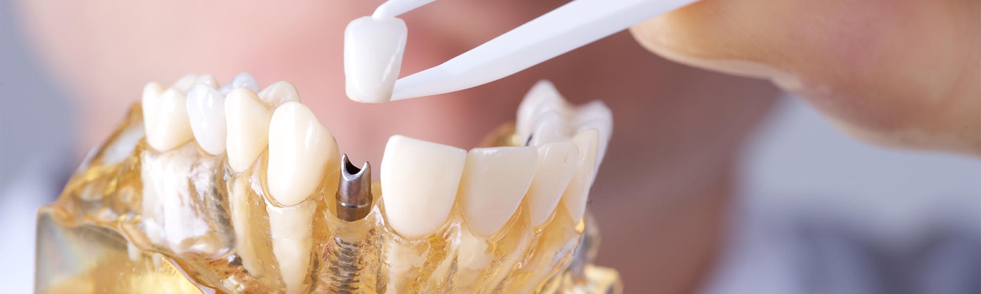 Dental Implants Torrance CA
