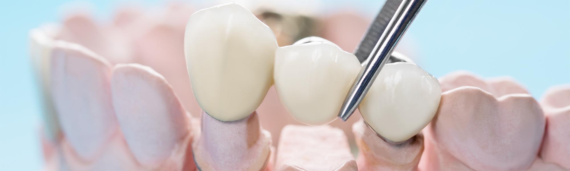 Three-tooth porcelain fixed bridge on a dental model, Torrance CA