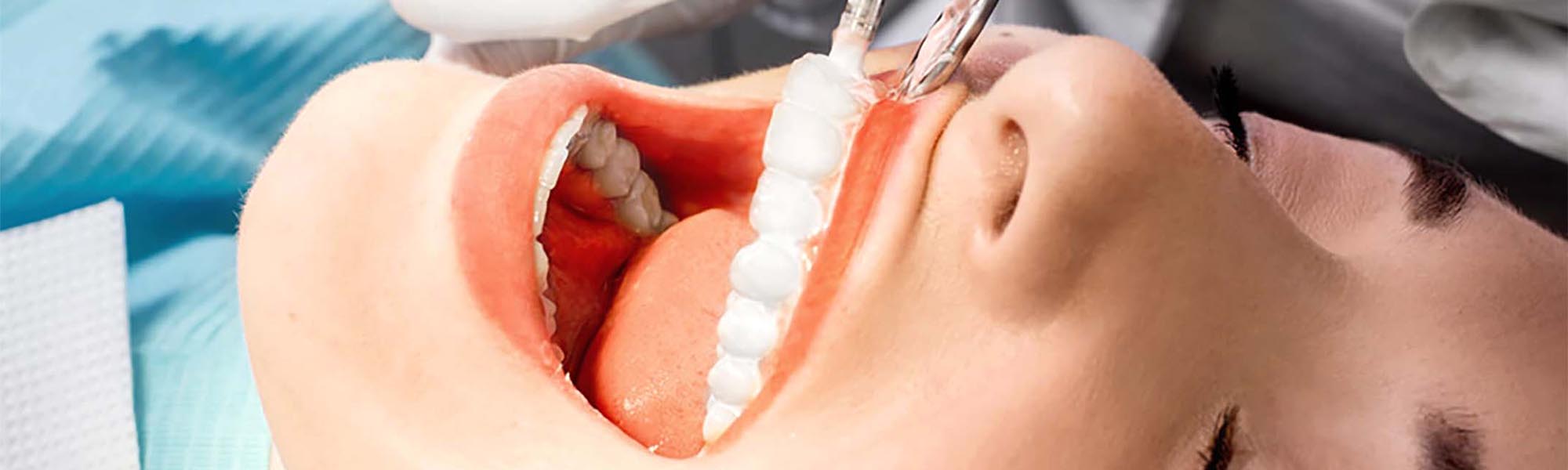 Fluoride Treatment Dentist Torrance CA