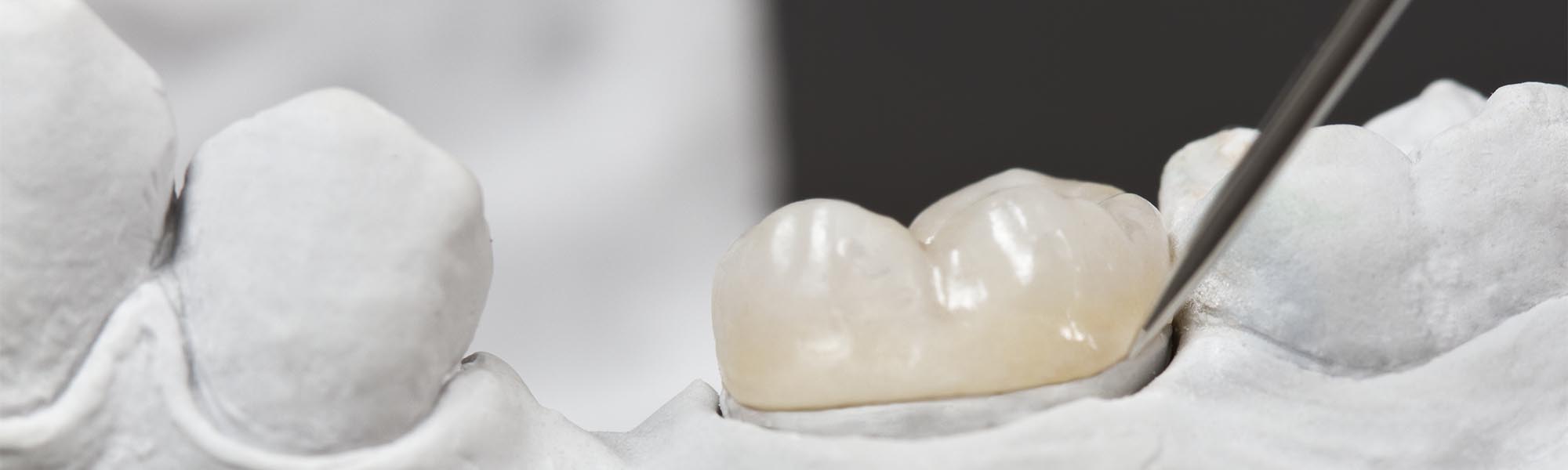 Tooth-colored porcelain onlay fitted on a dental model, Torrance CA