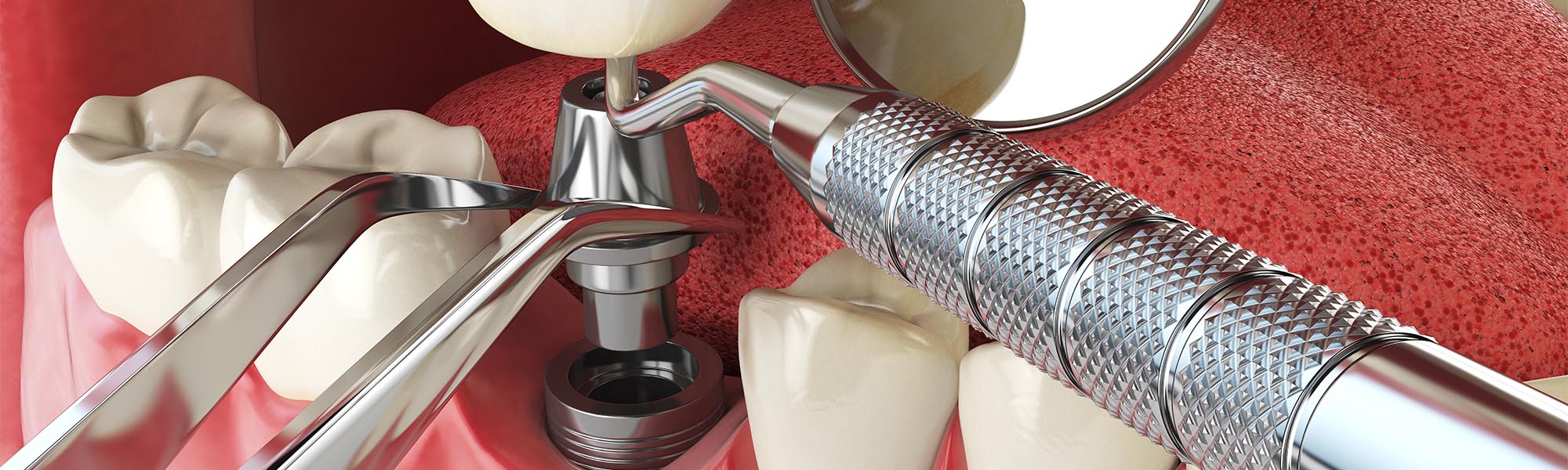 Multiple Teeth Implants Torrance CA